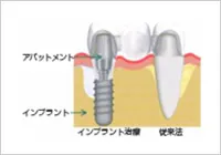 Straumann® Implant