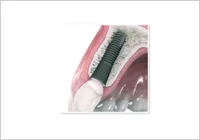 Astratech Implant