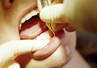 歯周病の外科的治療